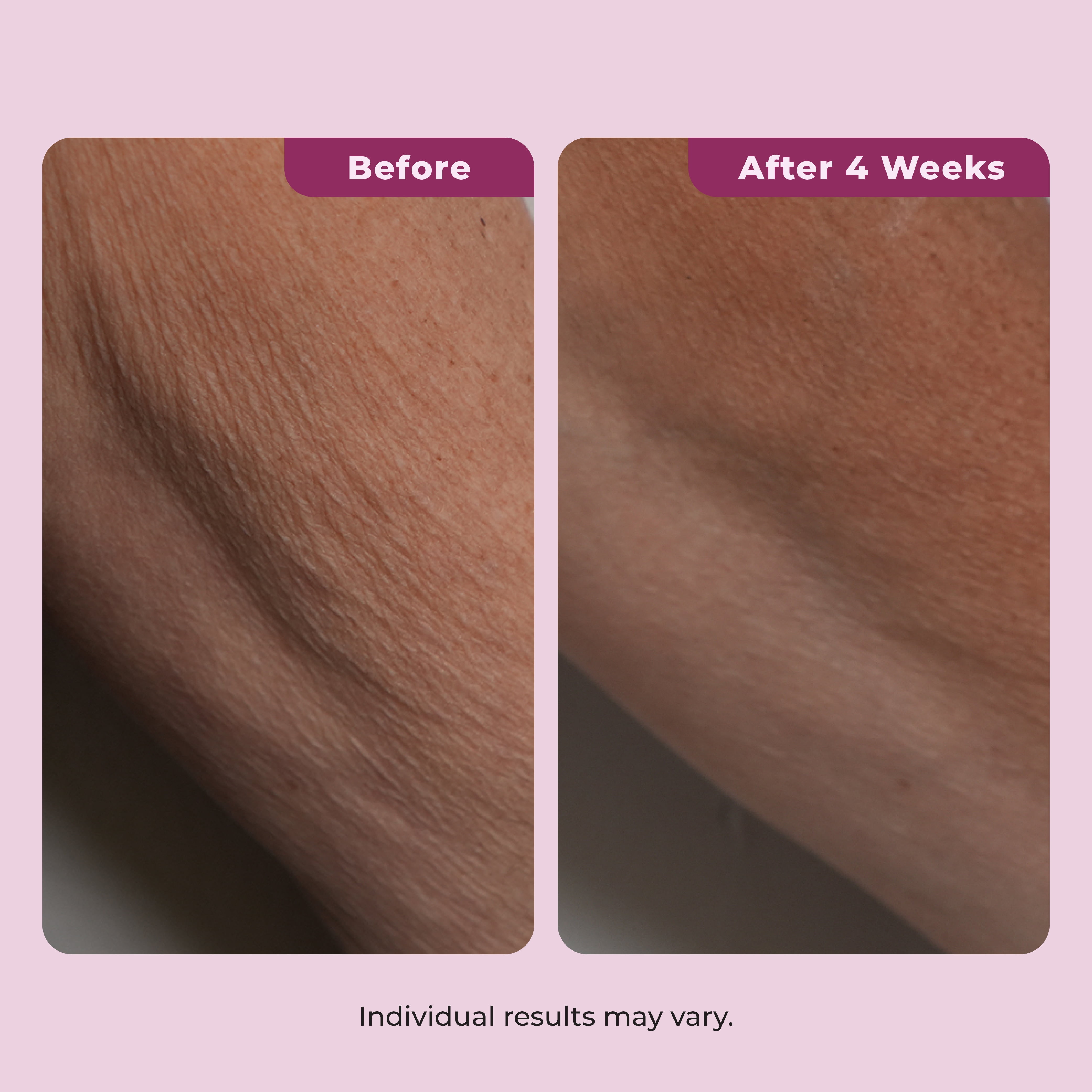 Dekliderm Neck Firming Cream for Neck, Chest & Arms – Tightening and Smoothing Cream for Crepey Skin, Wrinkles & Sagging Appearance