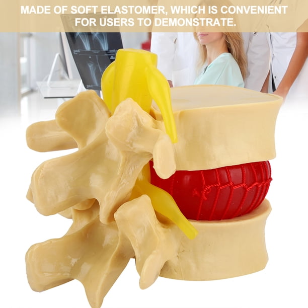 Modelo De Hernia De Disco Lumbar Humano, Portátil Profesional Práctico 1:1.5 Vértebras Lumbares Humanas Degenerativas, Enseñanza Clínica Para Ortopedia