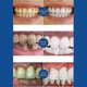 thumbnail image 3 of Quick repair of cavities caries removal of plaque stains rotting whitening yellowing repair teeth whitening, 3 of 4