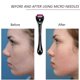 thumbnail image 3 of Juego de 3 microagujas de titanio para masaje facial antienvejecimiento, rodillo de belleza para el cuidado de la piel en casa, 540 agujas, 0,25 mm, 0,5 mm, 1 mm, negro y morado., 3 of 6