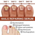 thumbnail image 5 of 2PCS Nail Repair Serum Fungal Nail Treatment Liquid Remove Onychomycosis Toe Essence, 5 of 5