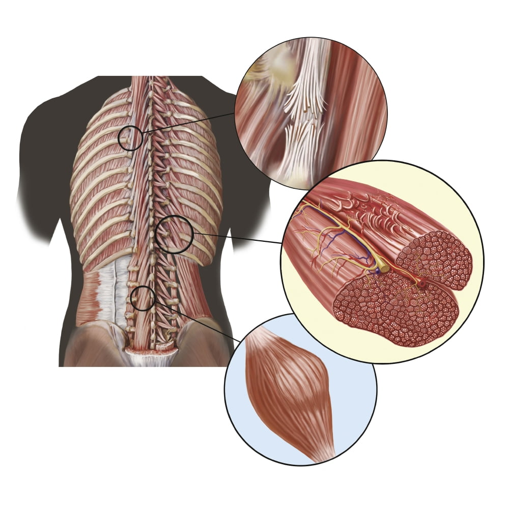 Detail of deep back muscles with a closeup of sprain, strain and spasm