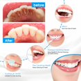 thumbnail image 4 of XIRQI Plaque Remover for Teeth,Tooth Scraper Polisher,Ultrasonic Tooth Cleaner Dental Tartar Calculus Remover with LED Light Teeth / 5 Adjustable Modes,Cleaning Kit Safe for Adult Kids (White), 4 of 6
