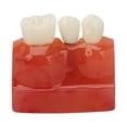 thumbnail image 2 of Modelo De Implante Dental, Resina De Modelo De Dientes De Implante Seguro Para Educación, 2 of 7