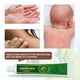 thumbnail image 2 of Crema para eczema, dermatitis, prurito, psoriasis, ungüento antipicazón, 2 of 7
