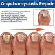 thumbnail image 4 of 60pcs Toenail Fungus Treatment Stickers Ingrowning Toenail Nail Repair Patch, 4 of 5
