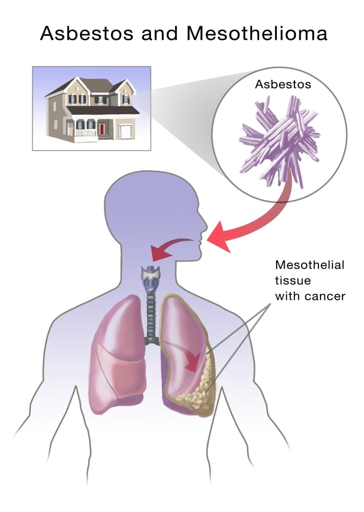 Asbestos And Mesothelioma Poster Print By Spencer Sutton/Science Source ...