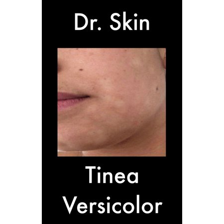 Tinea Versicolor - eBook (Best Products For Tinea Versicolor)