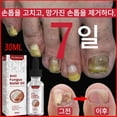 thumbnail image 4 of West & Month-Tratamiento de hongos Nailr, esencia para el cuidado de los pies, Gel antiinfección para la eliminación de hongos en las uñas de los pies, paroniquia y onicomicosis, 4 of 5