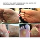 thumbnail image 5 of Eliminación De Marcas En La Piel Eliminación De Verrugas 10ml Etiqueta De La Piel Verrugas Pie Eliminación De Maíz Tratamiento Salud Piel Cuidado De Los Pies Líquido ANGGREK GF1411, 5 of 8