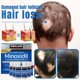 thumbnail image 2 of Minoxidil líquido, tratamiento regenerador intenso para la caída del cabello en hombres, solución tópica al 5 %, 2 of 6