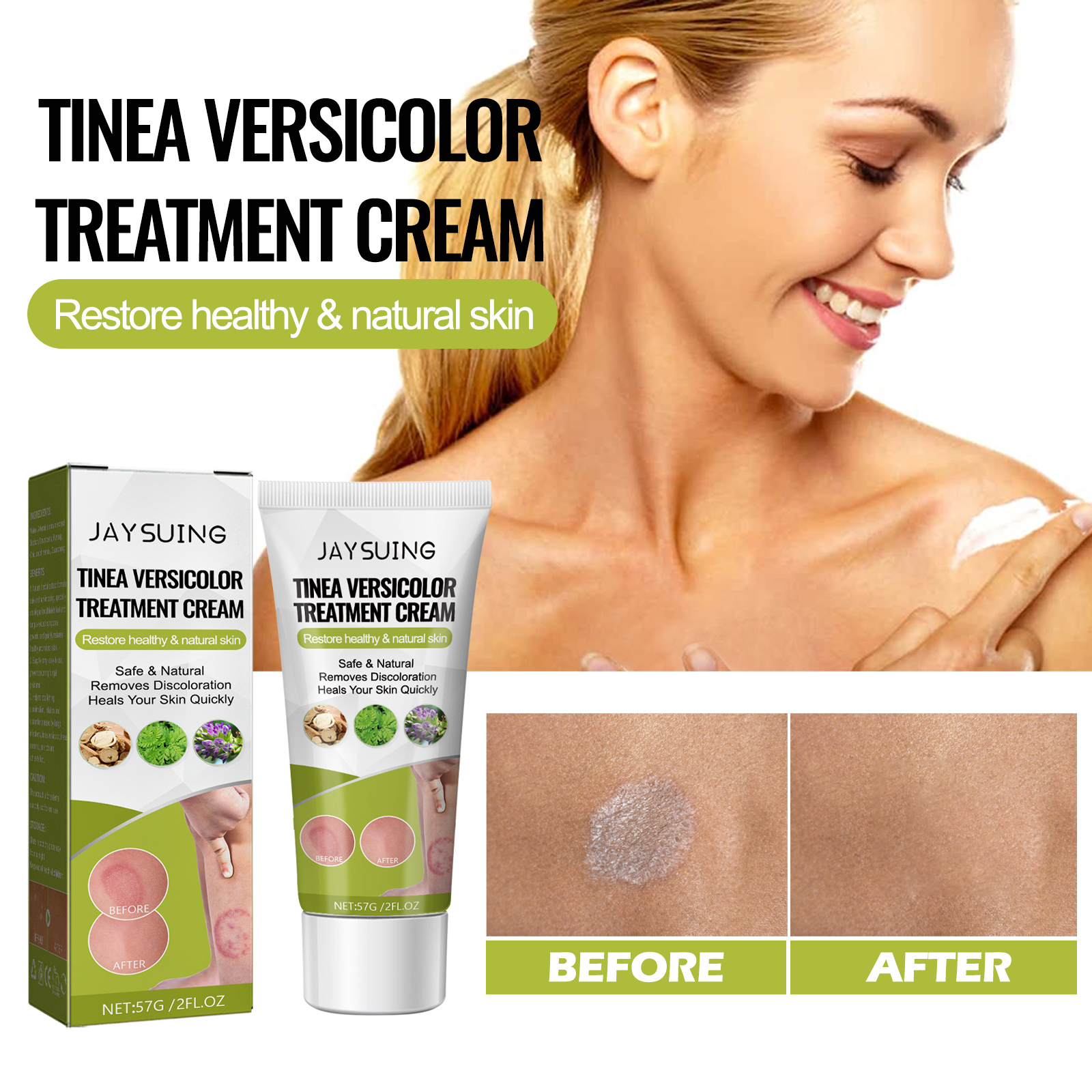 Roycederm Tinea Versicolor Treatment Antifungal Cream For Tinea