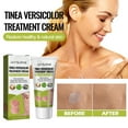 Roycederm Tinea Versicolor Treatment Antifungal Cream For Tinea