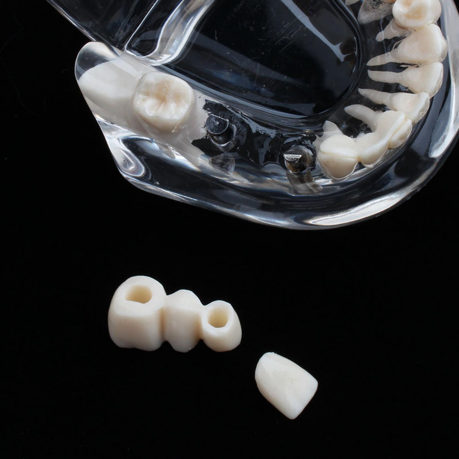 EOTVIA Detachable Tooth Model, Fixed Prosthetic On Implant For Offices