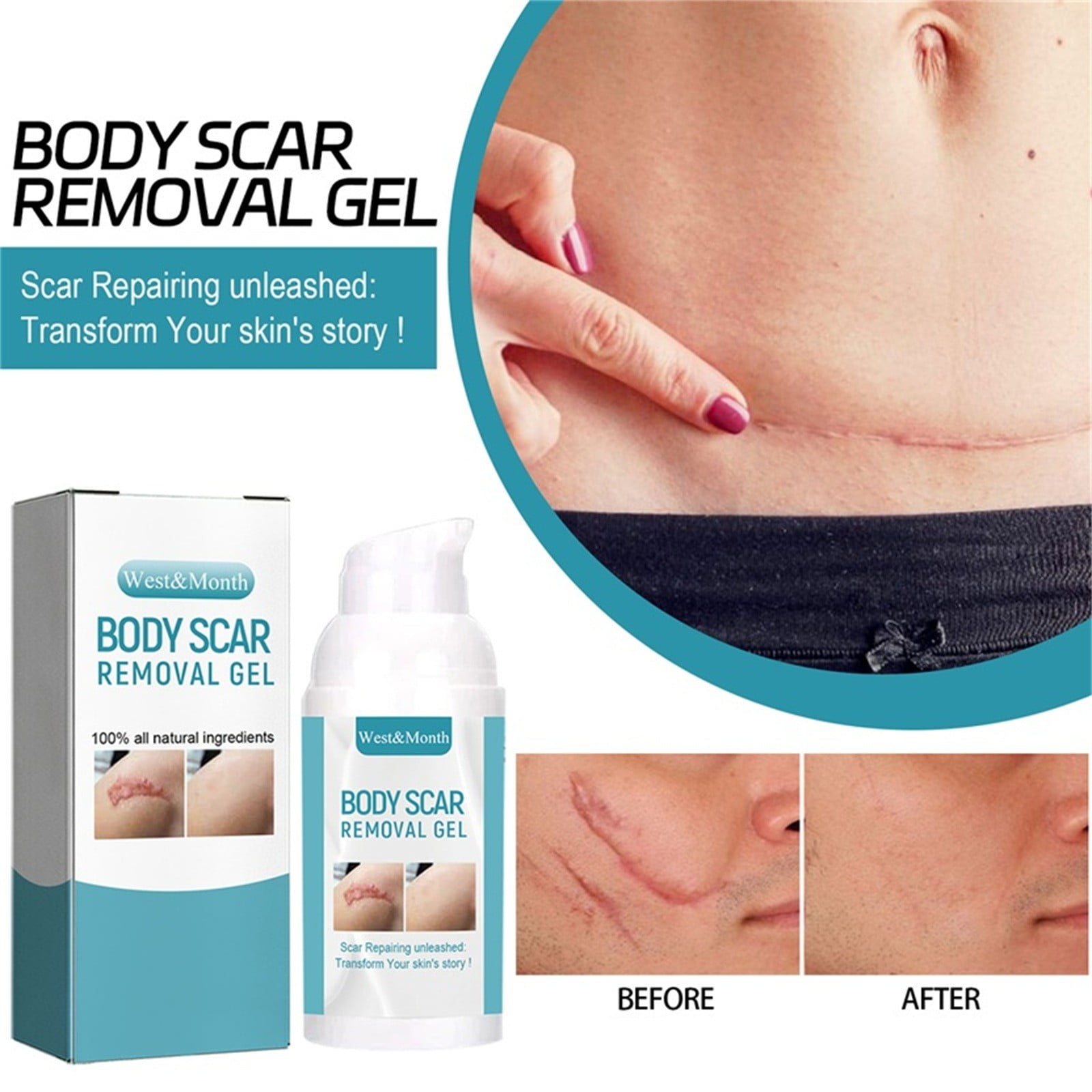 Komiseup Scar Cream, for C-Section, Tummy Tuck, Keloid, and Surgical Scars, Stretch Marks, Keloids,Scar Treatments for Old & New Scars,Scar Removal for Women Men