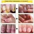 thumbnail image 4 of Ibealee Nail Fungus Treatment Essence Serum Fungal Removal Repair Gel Anti-infective Paronychia Onychomycosis, 4 of 5