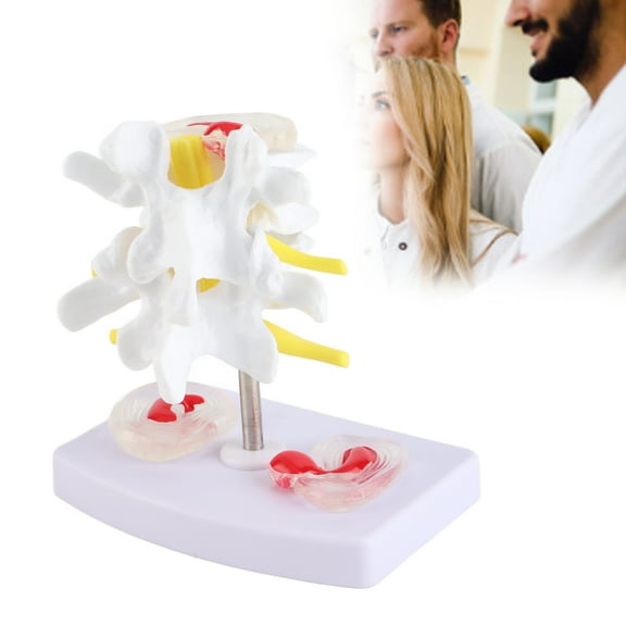 Anatomical Lumbar Disc Herniation Demonstration Model Human Spine School Training Supplies