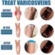 thumbnail image 4 of 4pcs Varicose Vein Massage Spray for South Moon - Say Goodbye to Leg Discomfort, 4 of 5