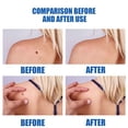 thumbnail image 4 of Removedor de verrugas Skin Tag Pen Professional Papillomas Moles Removal Pen (03) Ndcxsfigh Nuevos Originales, 4 of 9