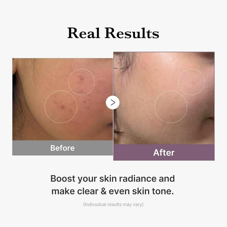 glutathione peptide before and after medicube Age-R Glutathione Glow Milky Toner, Low-Irritation Double Layer  Toner for Glass Glow Skin with Peptide, Even Skin Tone, Radiance,  Hydration, Korean Skincare