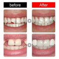thumbnail image 4 of Jaysuing Of Shapeable Teether Set Party Makeup Temporary Filling Tooth Cavity Filling Denture Modification |, 4 of 5
