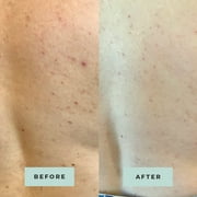 Miami Beach Bum, Bum + Body Cream Clears Acne, Ingrown Hairs, Razor Bumps and Dark Spots, 6.7oz, Orange