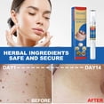 thumbnail image 3 of Removedor de verrugas Skin Tag Pen Professional Papillomas Moles Removal Pen (02) Ndcxsfigh Nuevos Originales, 3 of 8