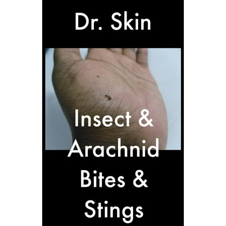 Insect and Arachnid Bites and Stings - eBook