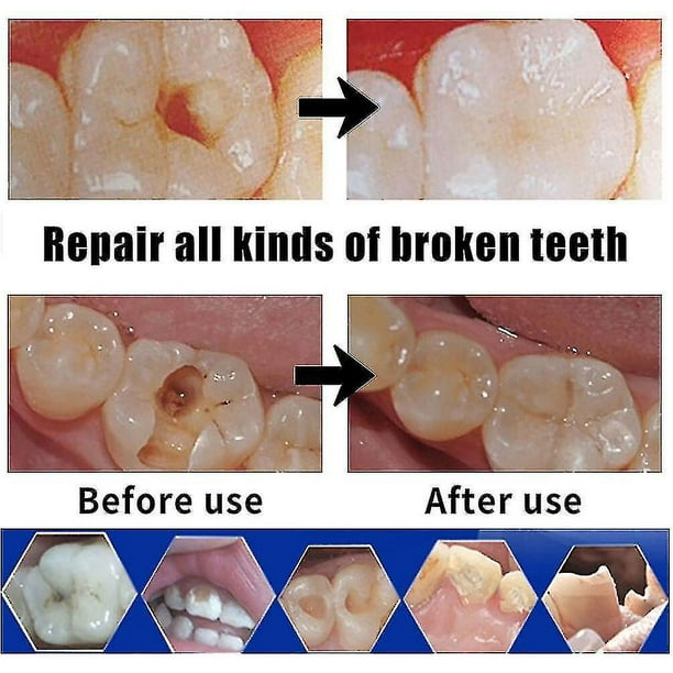 Tooth cement sale