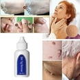 thumbnail image 3 of Agente eliminador de verrugas genitales de 30 ml Líquido para eliminar verrugas Eliminador de lunares, 3 of 5