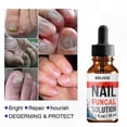 thumbnail image 5 of Nail Fungal Treatment and Repair Solution for Fingernails and Toenails, 1-3 Pieces, 5 of 5