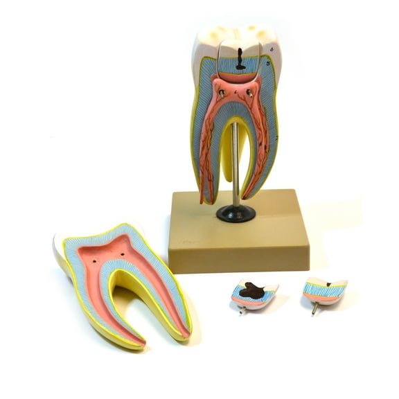 Eisco Labs Human Upper Triple Root Molar with interchangeable cavities, 6 parts