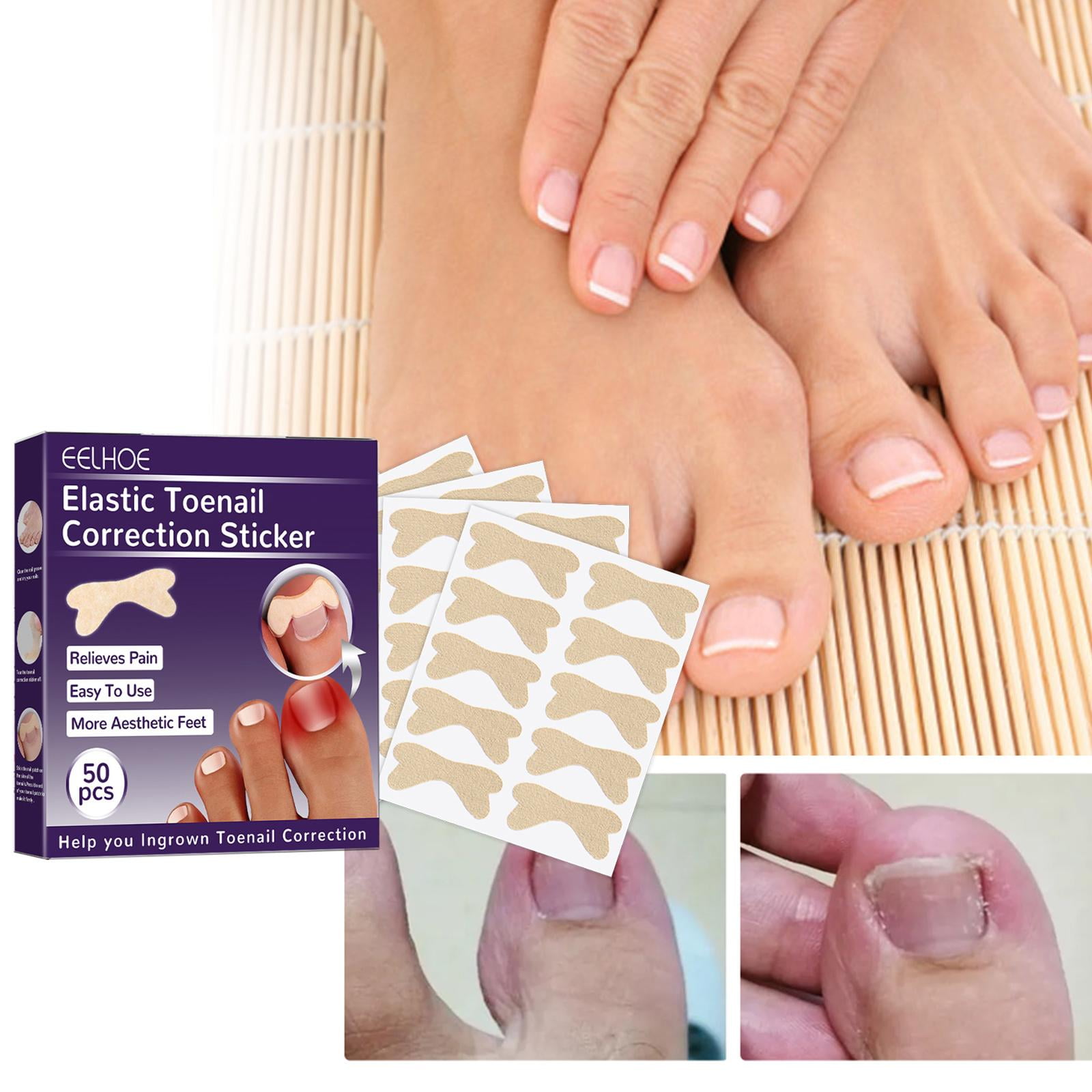 Ingrown Toenail Correction Patch, GlueFree Ingrown Toenail Corrector