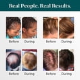 thumbnail image 2 of Shapiro MD Hair Loss Shampoo and Leave in Conditioner, DHT Fighting Vegan Formulas for Healthier, Fuller & Thicker Looking Hair, 1 Month, 2 of 6