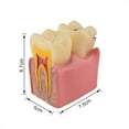 thumbnail image 6 of Dental Tooth Decay Model 6 Times Dental Caries Teeth Model, 6 of 7