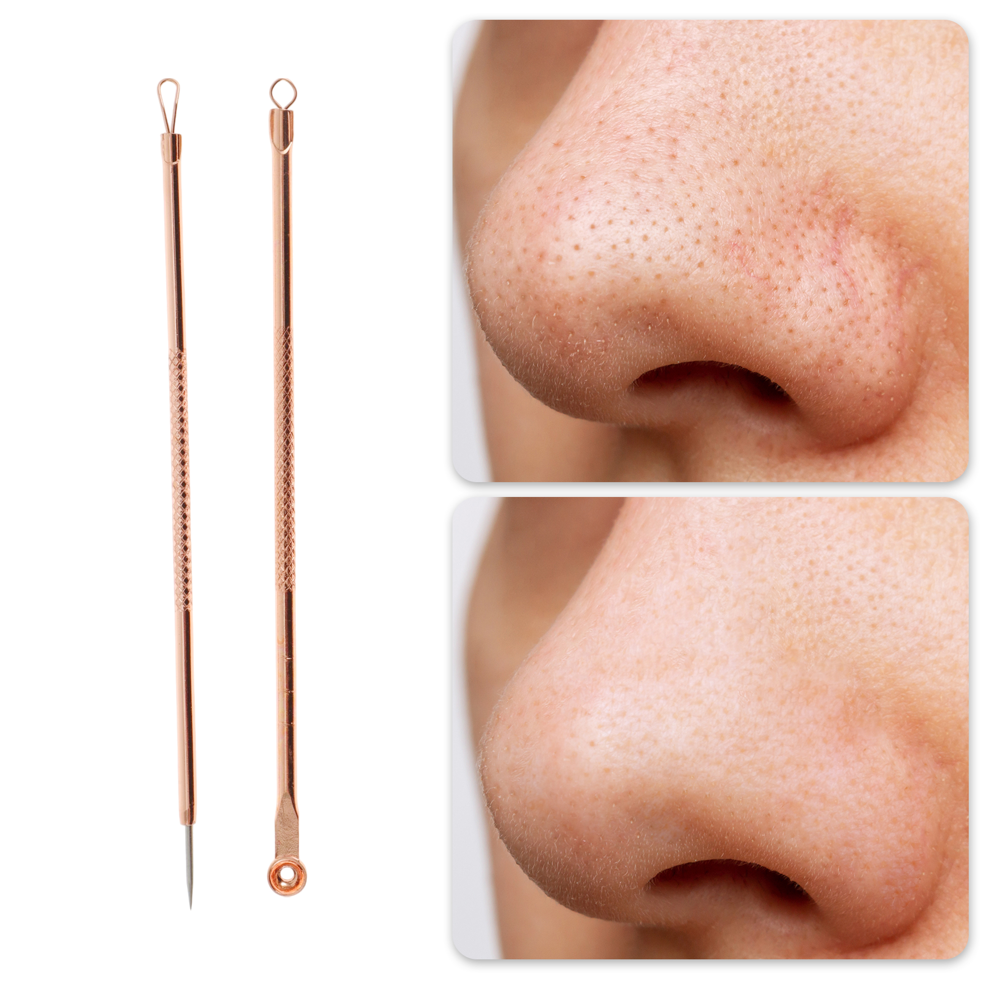 Unique Bargains Professional Portable Pimple Extractor Tool Kit Rose Gold Tone