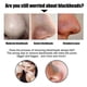thumbnail image 2 of Blackhead Nose Patch, Blackhead Pore Strips, Deep Charcoal Pore Cleansing Strips, Nose Blackhead Remover Strips for All Ski, 2 of 5