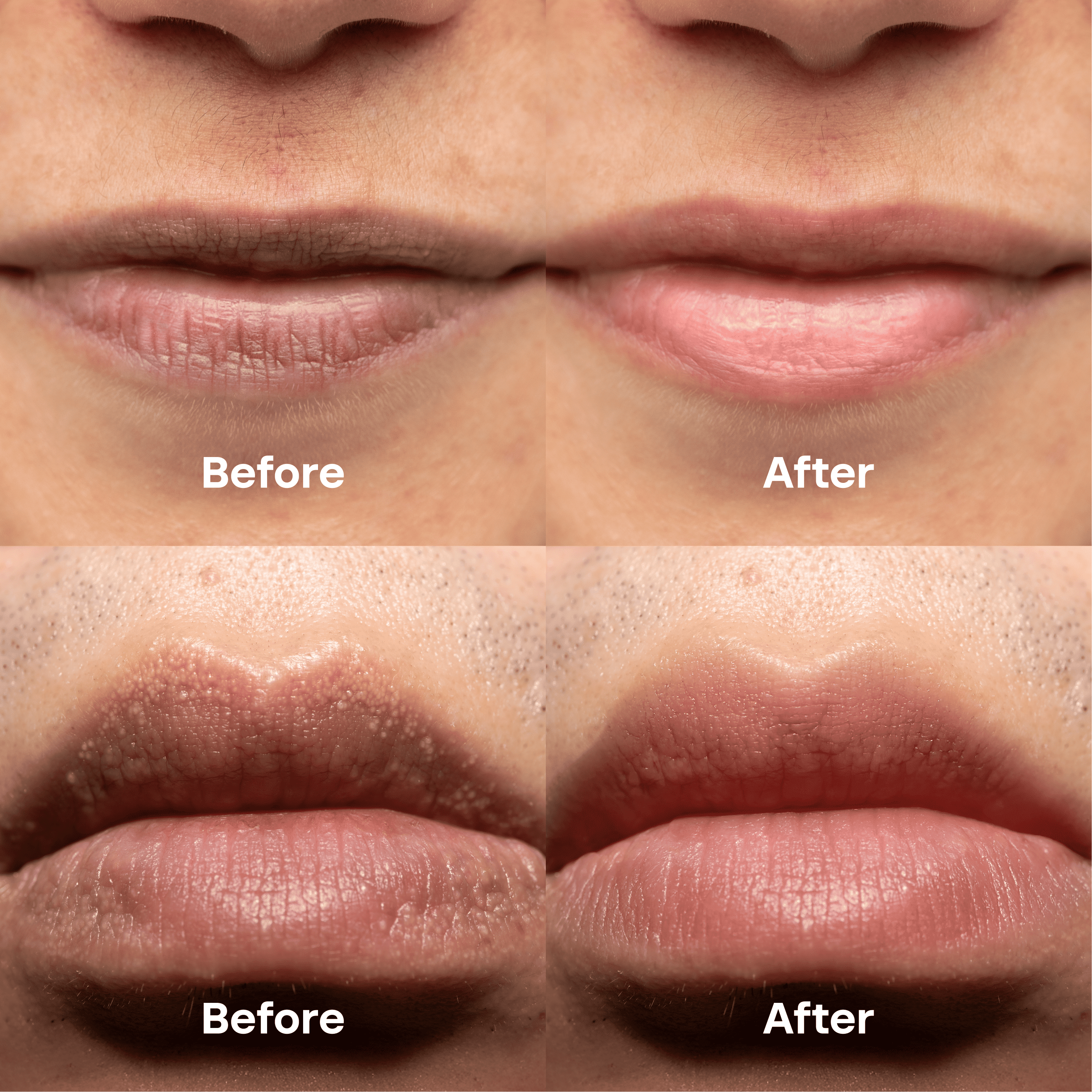 ABERA Fordyce Spot Lip Cream with HPR Retinoid, Moisturizing Repair For Dry Chapped Lips, 0.7 fl oz - Combo 2