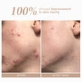 thumbnail image 4 of Sérum Shani Darden Rescue con 10% de complejo azelaico, 30 ml, vegano, 4 of 8