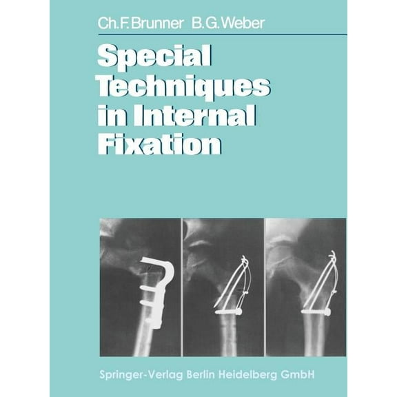 Special Techniques in Internal Fixation, (Paperback)