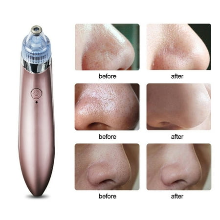 Blackhead Remove Bluelans Pore Cleaner Deep Cleansing Dead Skin Blackhead Remover Face Massager Skin (Best Way To Remove Deep Blackheads)