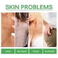 thumbnail image 3 of BUY 2 SAVE 10%!Maojin Acné Corporal, Para Eliminar Acné, Espinillas Y Acantosis Nigricans, Acné Corporal Para El Cuerpo, Peeling De Acné Para Espalda Y Glúteos Etc 30ml, 3 of 8