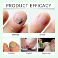thumbnail image 4 of 7-day Tea Tree Ginger Nail Fungus Treatment Nail Renewal Liquid Strengthening For Damaged Toenails, 4 of 5