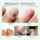 thumbnail image 4 of 7-day Tea Tree Ginger Nail Fungus Treatment Nail Renewal Liquid Strengthening For Damaged Toenails, 4 of 5