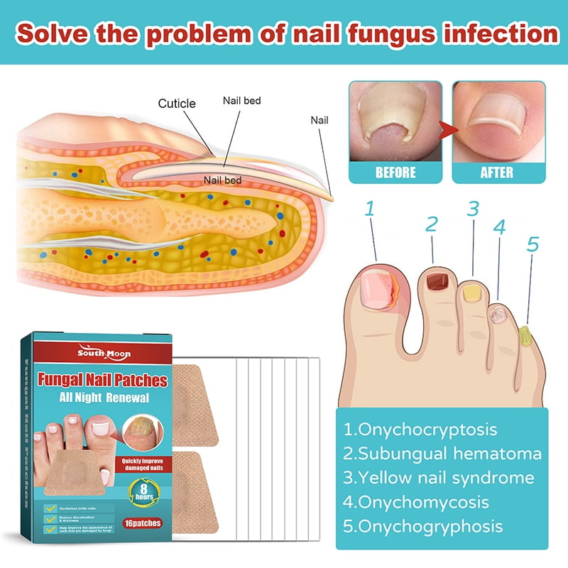 Yiget 16PCS Night Repair Correction Sticker Anti Fungal Toe Thickening