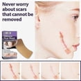 thumbnail image 3 of Silicone Scar Stickers Dilute Scars Caesarean Section Surgery Scar Hyperplasia Scar Silicone Repair Sticker, 3 of 5