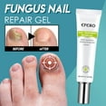rskk-nail-repair-cream-gel-toe-removal-nail-feet-care-nail-personal