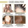 thumbnail image 4 of 1-3pcs Hair Regrowth Serum Natural Hair Growth Treatment | With Rosemary Essential Oil, 4 of 5