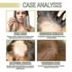 thumbnail image 4 of 1-3pcs Hair Regrowth Serum Natural Hair Growth Treatment | With Rosemary Essential Oil, 4 of 5