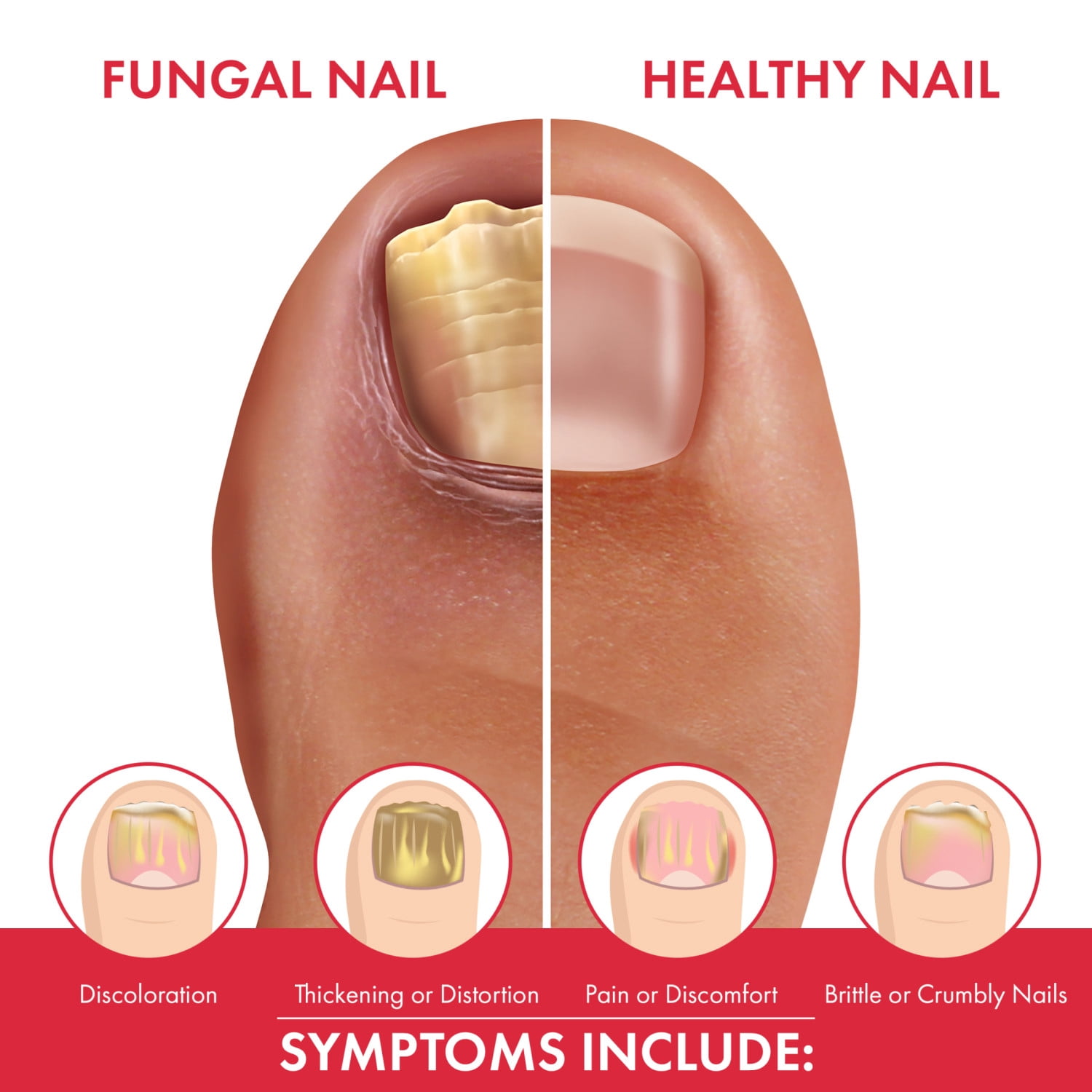 ProClearz Fungal Nail Renewal Solution 3-in-1 Action 0.43 fl oz